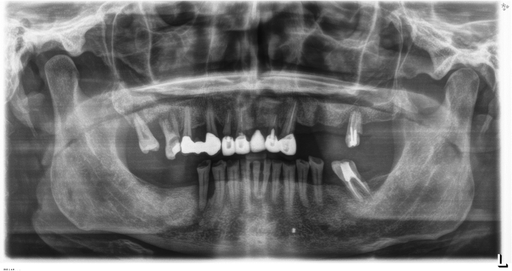 3-caso-clinico-espai-dental